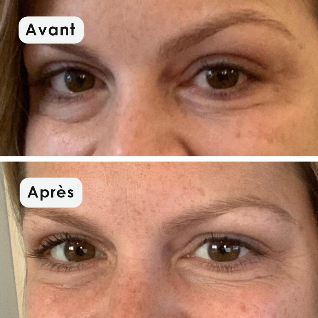 Patchs Yeux PDRN & Rétinal